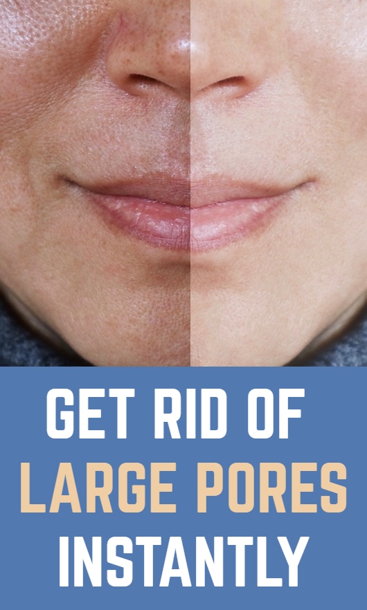 Get Rid Of Large Pores Instantly Healthy Solutions