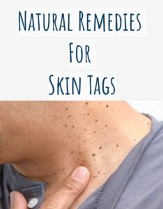 NATURAL REMEDIES FOR SKIN TAGS