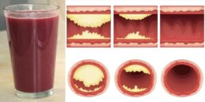 Cleanse Your Clogged Arteries With This Drink