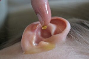 Remove All Your Earwax With Home Remedies At Home