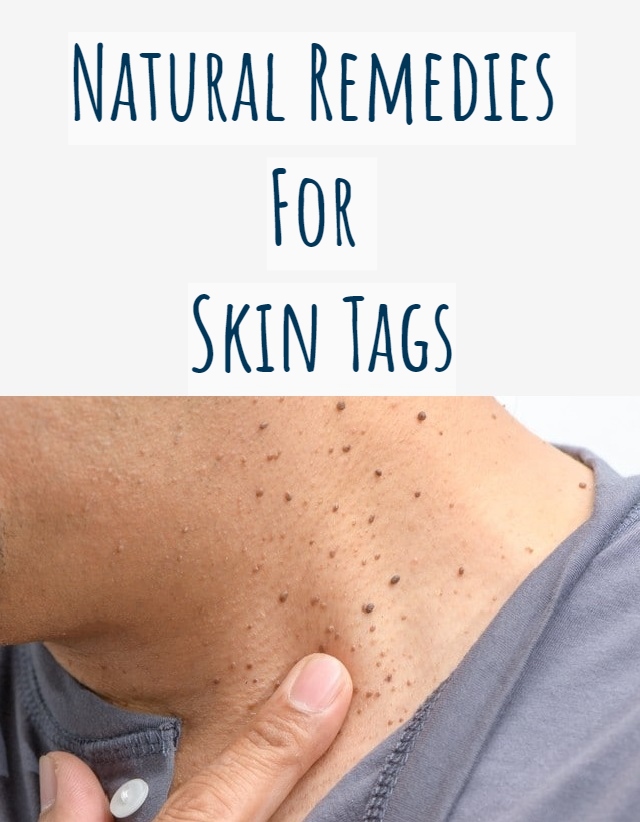 NATURAL REMEDIES FOR SKIN TAGS - Healthy Solutions